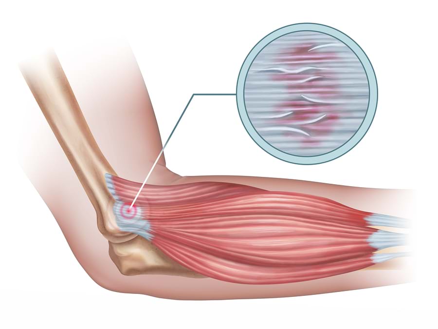 Tennis Elbow symptoms and causes Essendon Physio Group